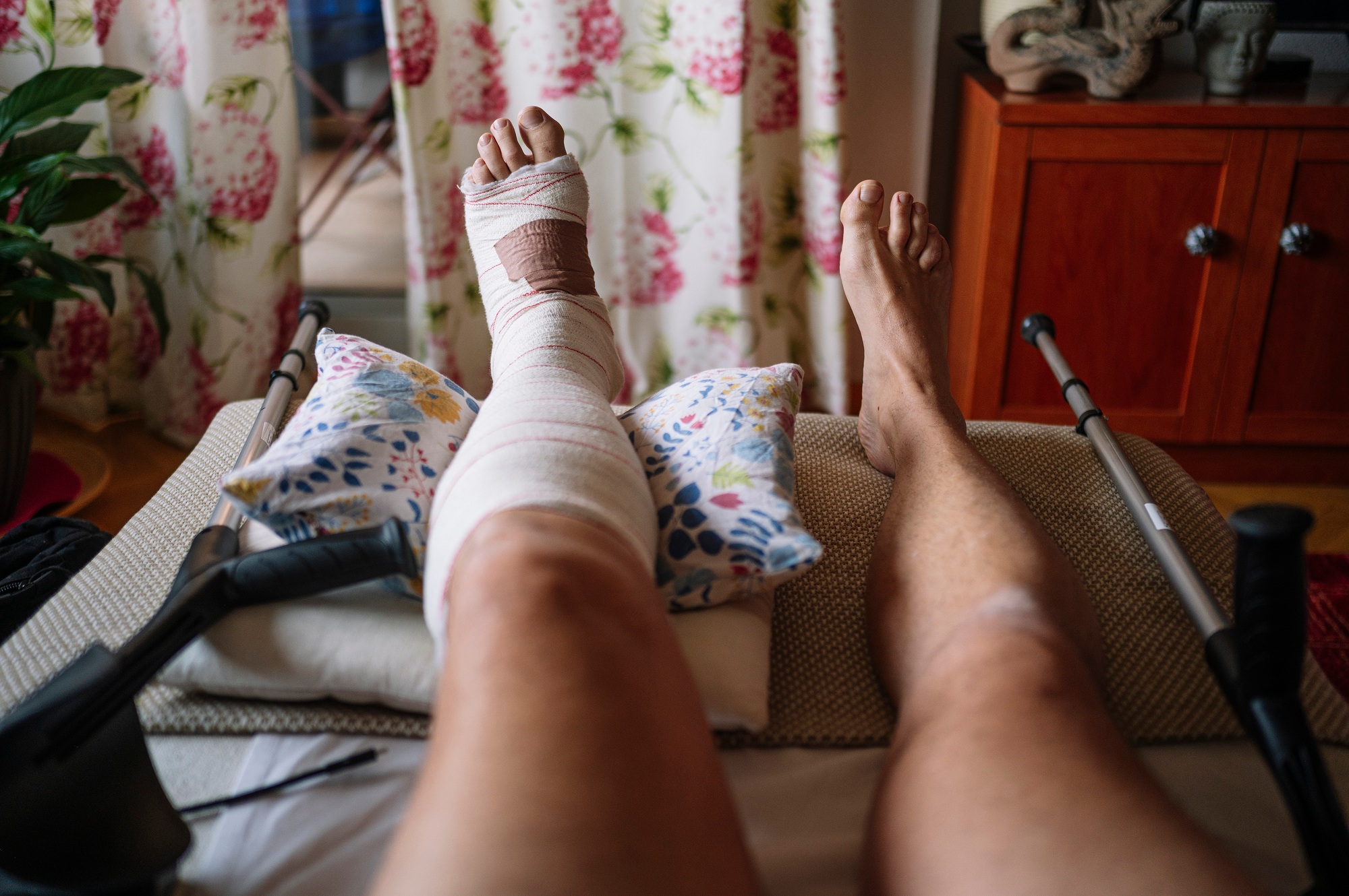 Fractured foot with a bandage made by a doctor.