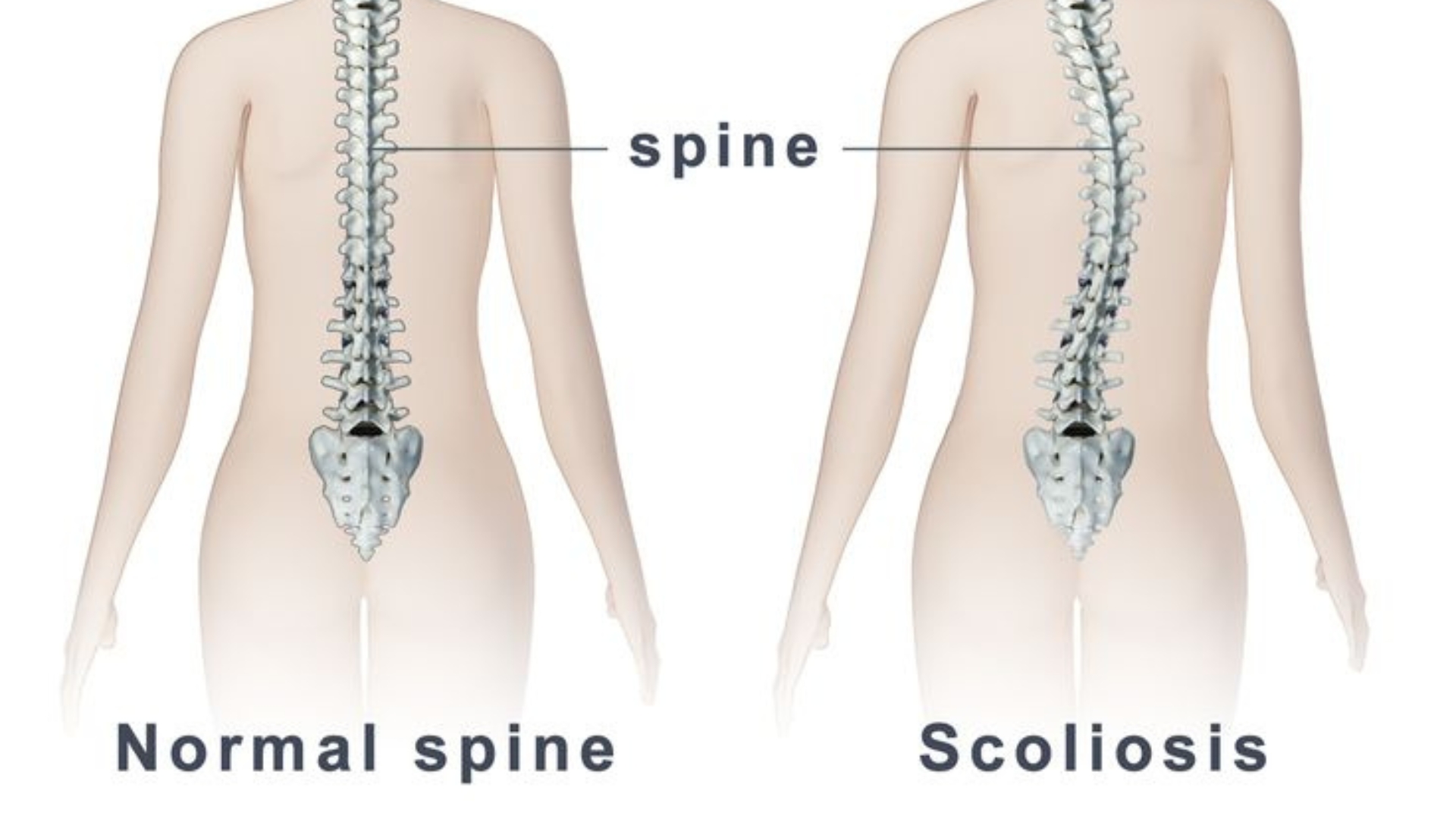 Understanding Scoliosis